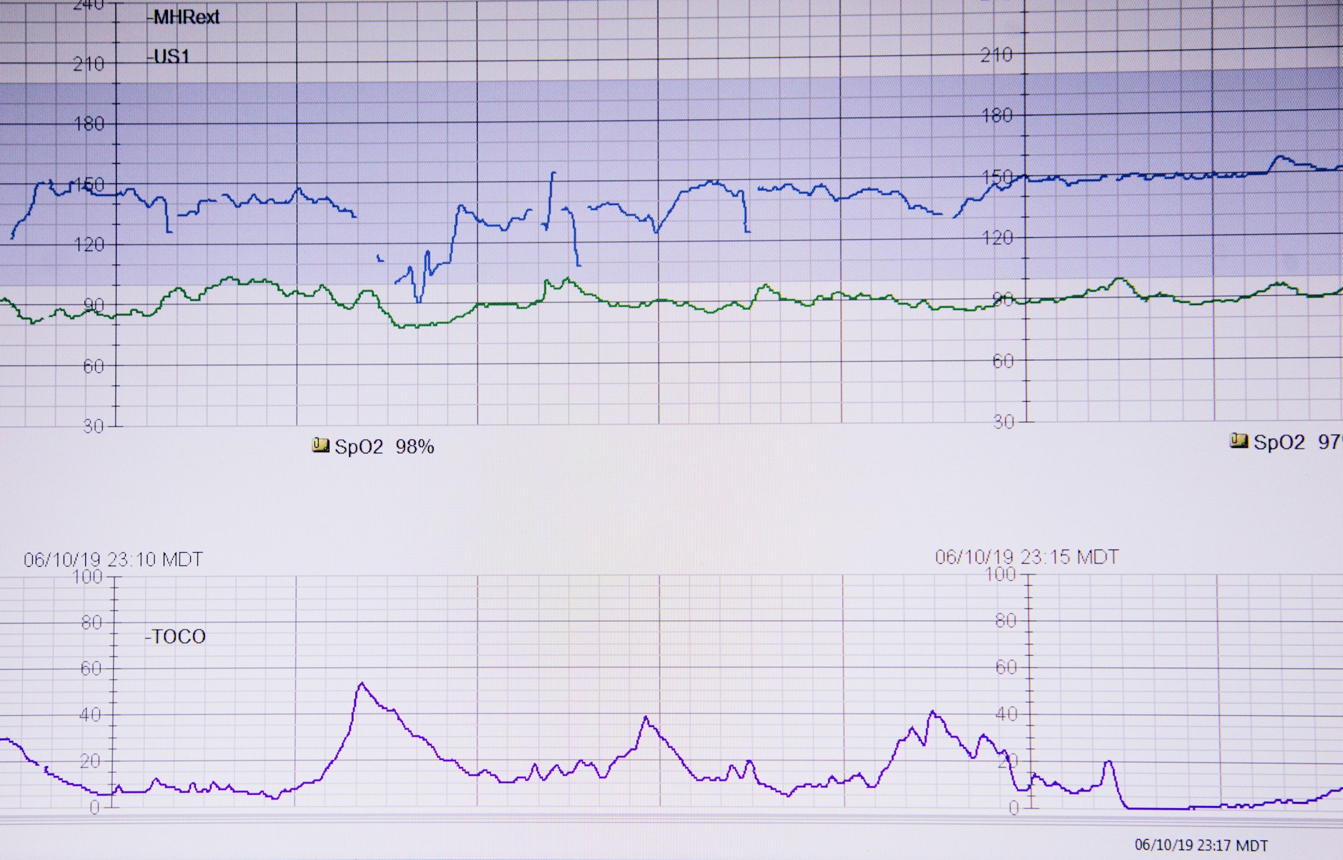 Acute Myocardial Infarction: How to Get Help On Time and for Free