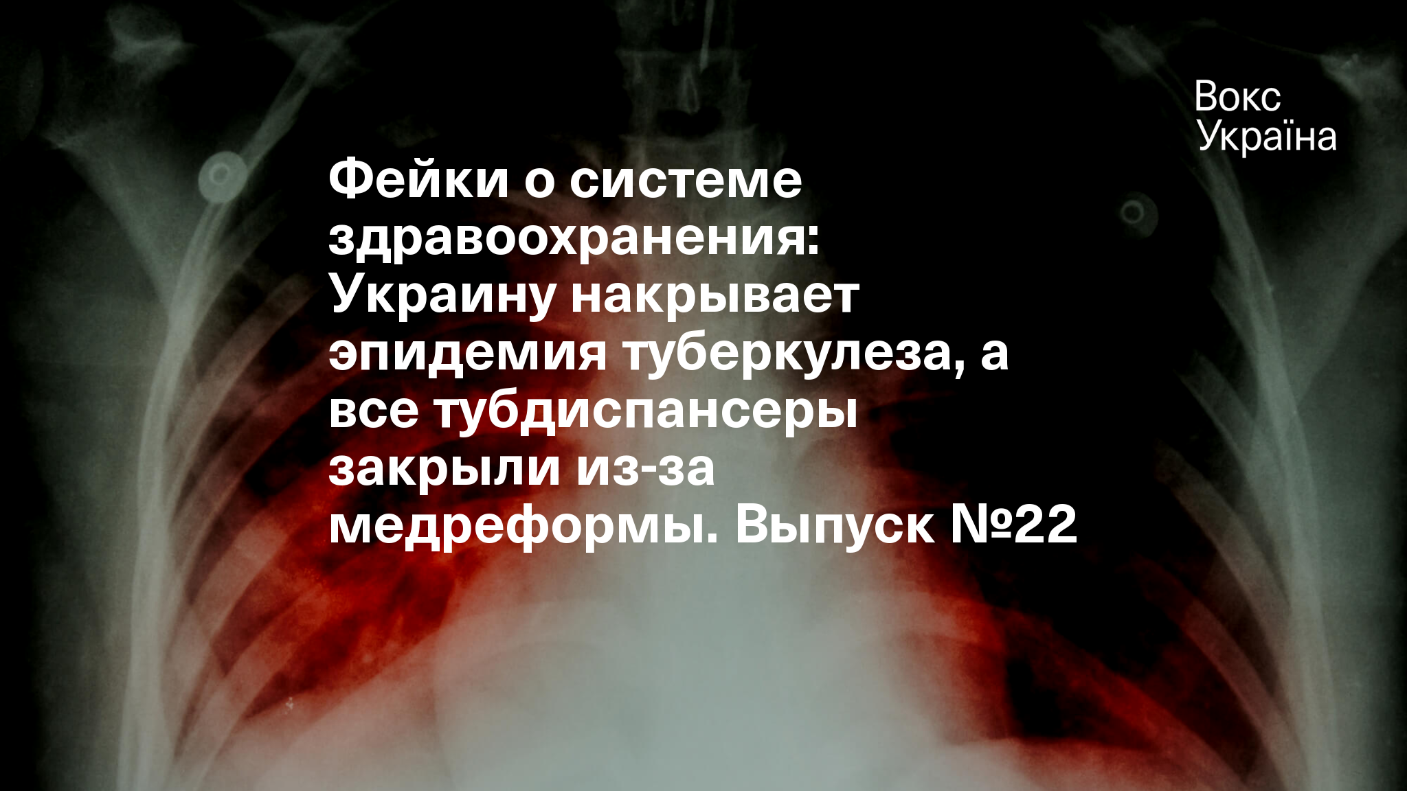 В Украине почти 20 тысяч новых больных туберкулезом - Минздрав